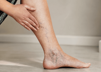 Varicose Veins During and After Pregnancy: What’s Normal, What’s Not